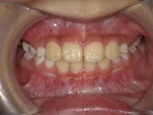 症例1（6歳男の子）（歯の向き・歯のデコボコ）