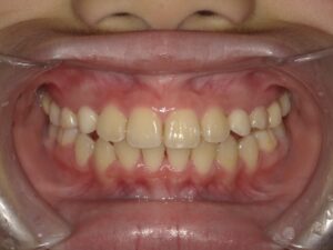 症例3（7歳女の子）（顎が小さい）（歯のデコボコ）