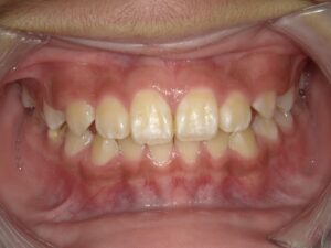 症例13（6歳男の子）（歯がガタガタ）