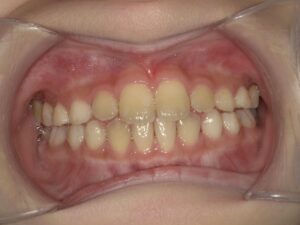 症例15（7歳女の子）（前歯がガタガタ）