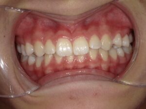 症例16（8歳女の子）（反対咬合・歯がガタガタ）